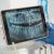 Root Canal Therapy services san jose, CA