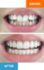invisalign-before-after-ramlaouidds