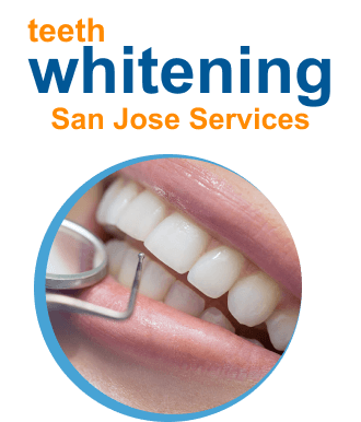 dental-teeth-whitening-sanjose-service-2-_1_