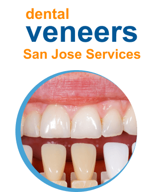 dental-veneers-sanjose-service-1-_1_