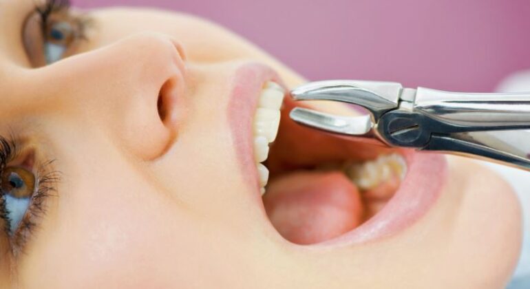 tooth extraction