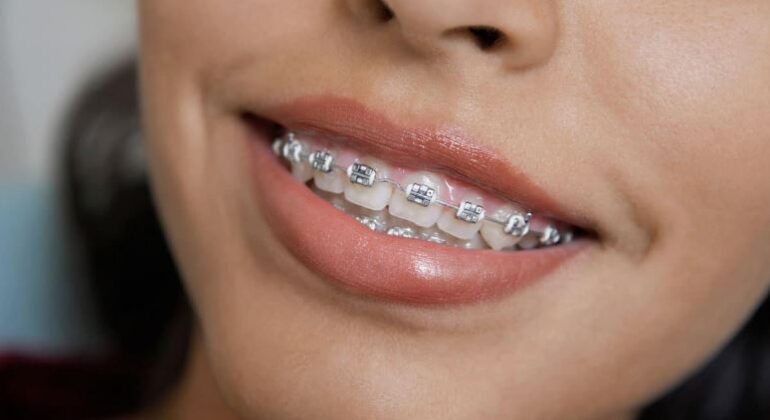 adult braces