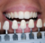 How long does a dental implant take