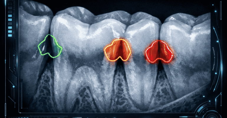 AI cavity detection