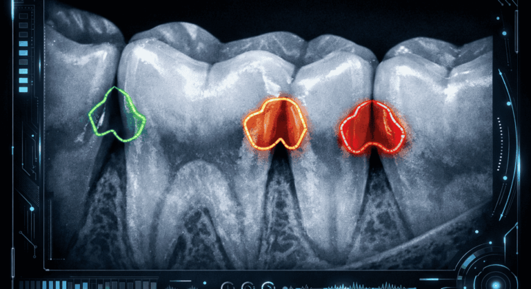 AI cavity detection