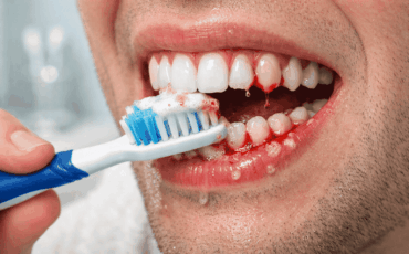 bleeding gums when brushing