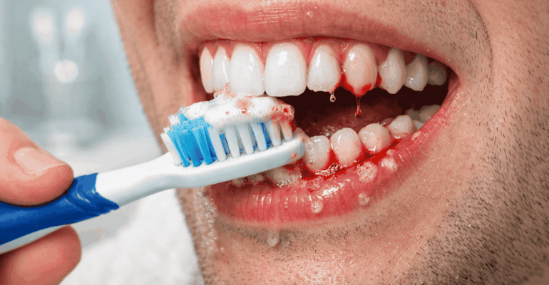 bleeding gums when brushing