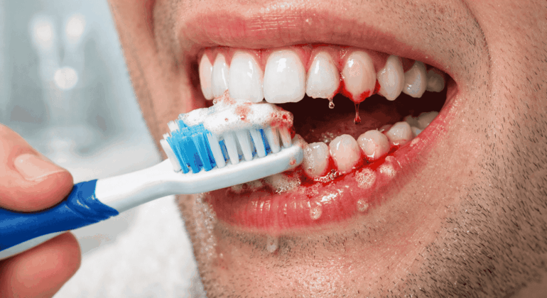 bleeding gums when brushing