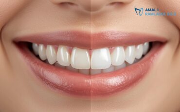 how-long-do-veneers-last