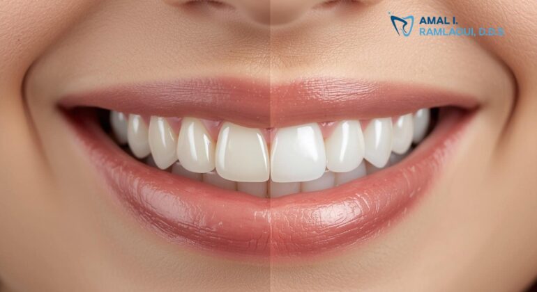 how-long-do-veneers-last