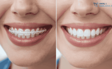 invisalign-vs-veneers