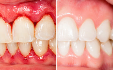 Gum disease