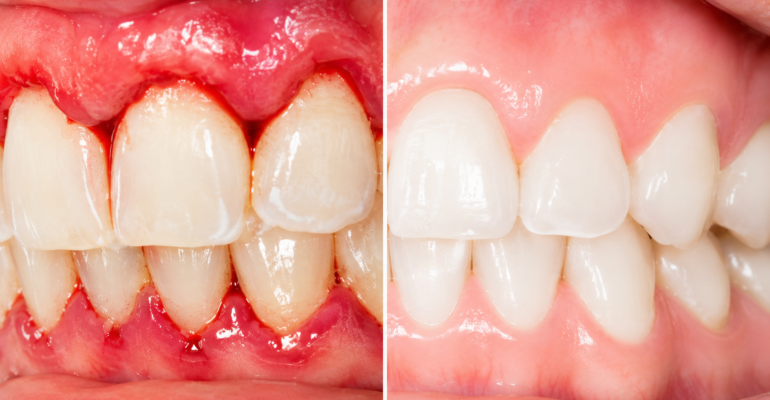 Gum disease