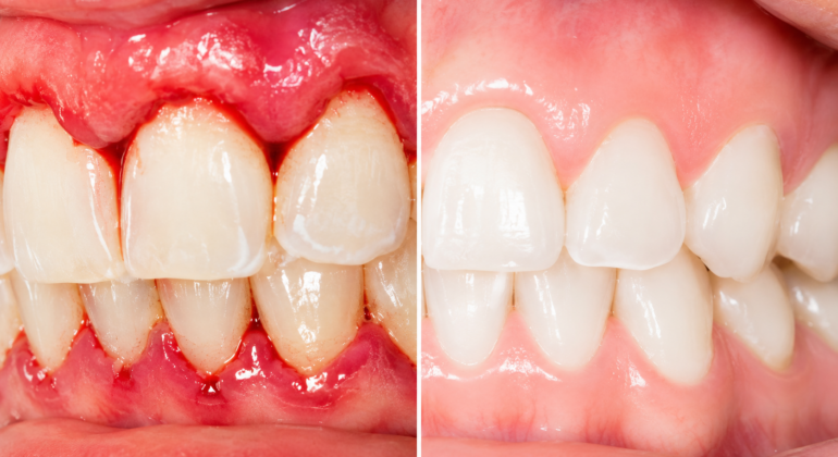 Gum disease